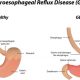 Heartburn Drugs Linked to up to 94% Increased Risk of Ischemic Stroke naturalsociety.com3226527-3440d496aec09a21072990fb53687d635331f83a